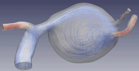 flow in aneurysm